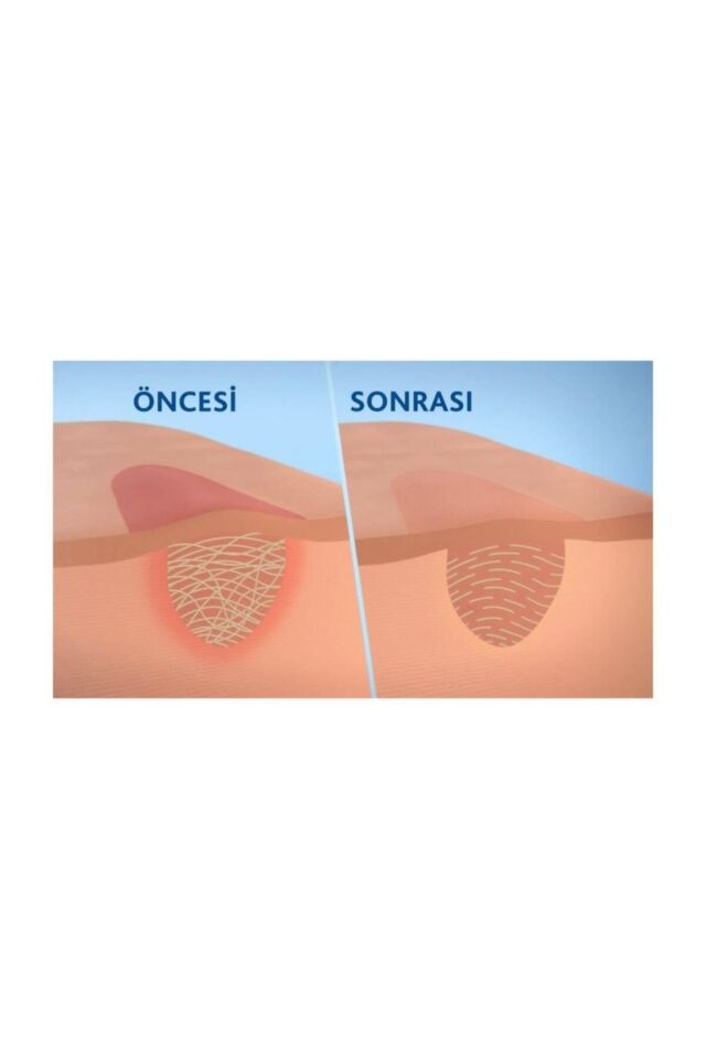 Anti-scar Jel 20gr | Yara Izi Için